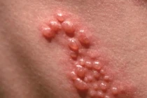 Hình ảnh bệnh tình dục phá nát cơ thể