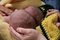 Thương tâm ca song sinh dính tim