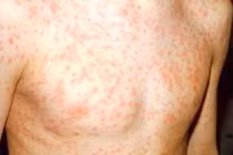 Các biến chứng nguy hiểm của bệnh sởi