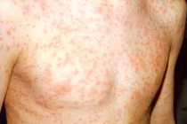 Các biến chứng nguy hiểm của bệnh sởi