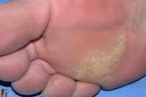 Mẹo trị vết chai sần ở chân do giày dép