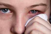 Nguyên tắc chăm con trẻ bị đau mắt đỏ 