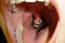 Kiểu xỏ khuyên miệng đau đớn nhất