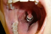 Kiểu xỏ khuyên miệng đau đớn nhất