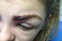 Hoại tử lông mày kinh hoàng do phun xăm làm đẹp