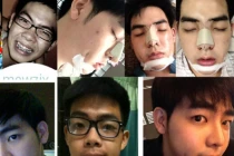 Dao kéo toàn bộ khuôn mặt để trở thành hotboy