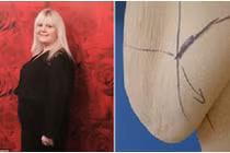 Da bụng chảy xệ đến đầu gối sau giảm cân