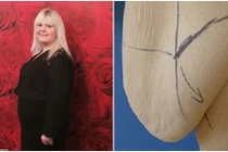 Da bụng chảy xệ đến đầu gối sau giảm cân