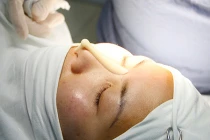 Phương pháp nâng mũi hot nhất hiện nay