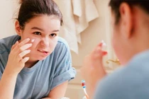 Sai lầm khi dùng thuốc trị mụn dễ để lại sẹo