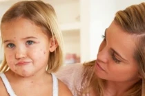 Phòng ngừa, điều trị cho trẻ bị thủy đậu