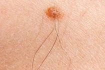 Biến chứng nguy hiểm do tự tẩy nốt ruồi