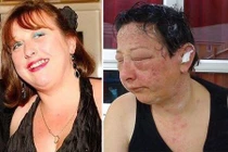 Khuôn mặt biến dạng khủng khiếp do dị ứng thuốc nhuộm tóc