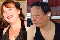 Khuôn mặt biến dạng khủng khiếp do dị ứng thuốc nhuộm tóc