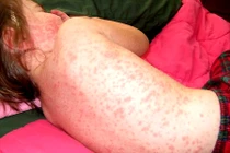 Dấu hiệu bé yêu bị sởi