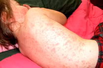 Dấu hiệu bé yêu bị sởi