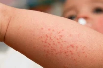 Cách phòng ngừa bệnh ngoài da cho trẻ mùa hè