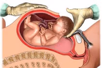 Trường hợp bà bầu bắt buộc phải mổ đẻ