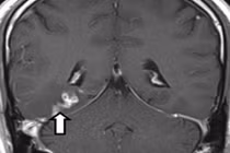 Kinh hoàng sán 5 cm ký sinh trong não người 4 năm