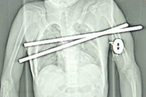 Những vụ sống sót thần kỳ dù bị đâm xuyên cơ thể