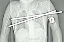 Những vụ sống sót thần kỳ dù bị đâm xuyên cơ thể