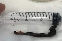 Phát hiện con vắt dài hơn 6 cm sống trong mũi bệnh nhân