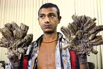 Khổ sở với căn bệnh tay, chân mọc tua tủa như rễ cây