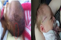 Thương tâm những trẻ sơ sinh bị bác sĩ mổ đẻ trúng người