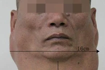  Kinh hãi chiếc cổ phình to như lạc đà vì 30 năm nhậu