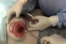 Những hình ảnh khiếp sợ về phẫu thuật nâng ngực
