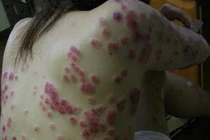 Hình ảnh khủng khiếp bệnh giang mai tàn phá cơ thể người