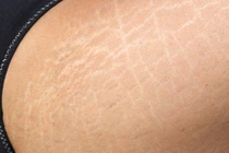 6 cách trị rạn da đơn giản không ngờ