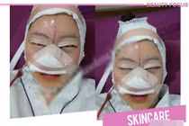 Những hình ảnh hết hồn về sửa mũi 