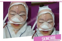 Những hình ảnh hết hồn về sửa mũi 