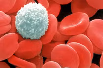 8 loại ung thư nguy hiểm gây ra từ bệnh thấp khớp