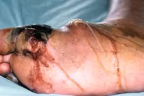 Loạt ảnh nổi da gà về cơ thể bị tiểu đường tàn phá