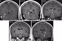 Những ký sinh trùng "ăn não" người khủng khiếp nhất