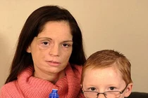 Đi khám răng mới biết mình bị ung thư miệng