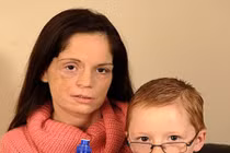 Đi khám răng mới biết mình bị ung thư miệng