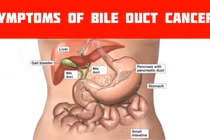Dễ bị ung thư ống dẫn mật nếu có triệu chứng này