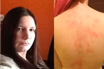 Hễ được chồng hôn là nổi mẩn, đau như bị ong châm