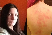 Hễ được chồng hôn là nổi mẩn, đau như bị ong châm