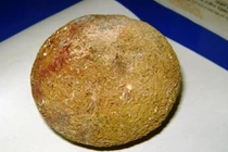 Sỏi thận “khủng” trú trong cơ thể 10 năm