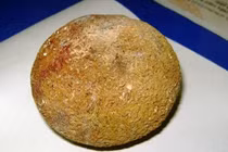 Sỏi thận “khủng” trú trong cơ thể 10 năm