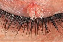 Trớ trêu chuyện gái ngoan dính sùi mào gà ở mắt