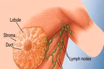 6 bài thể dục hiệu quả cho bệnh nhân ung thư vú