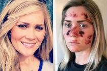 Hình ảnh ung thư da đáng sợ gây chấn động 