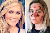 Hình ảnh ung thư da đáng sợ gây chấn động 