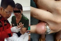 Cận cảnh ngón tay viêm lở khủng khiếp vì đeo nhẫn chật