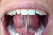 6 bài tập chữa ngủ ngáy hiệu quả nhất